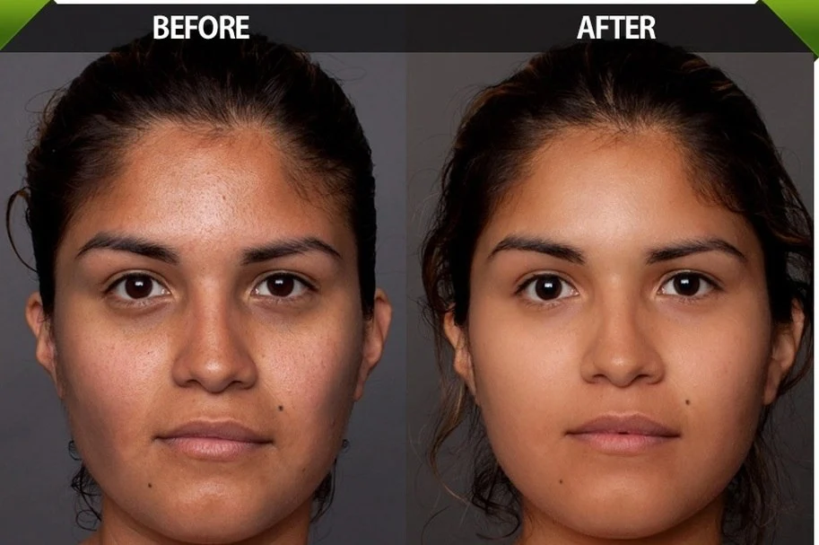 Mesotherapy before after