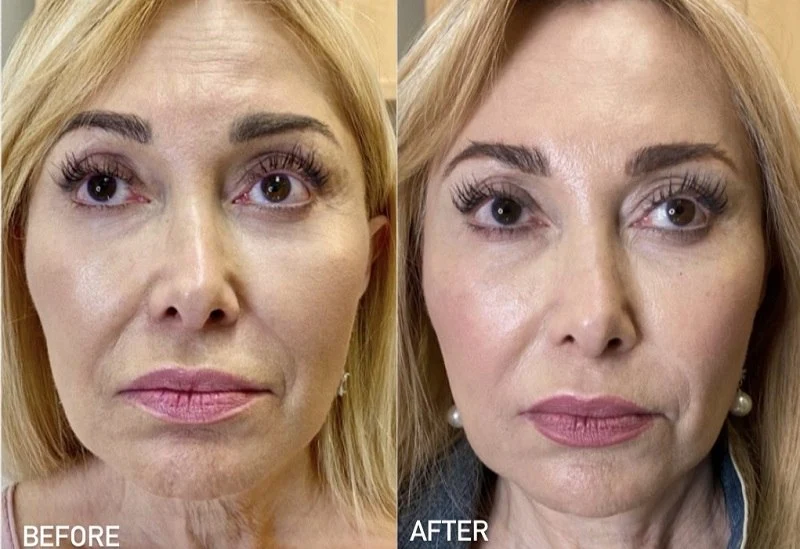 Morpheus 8 Treatment Before After Results