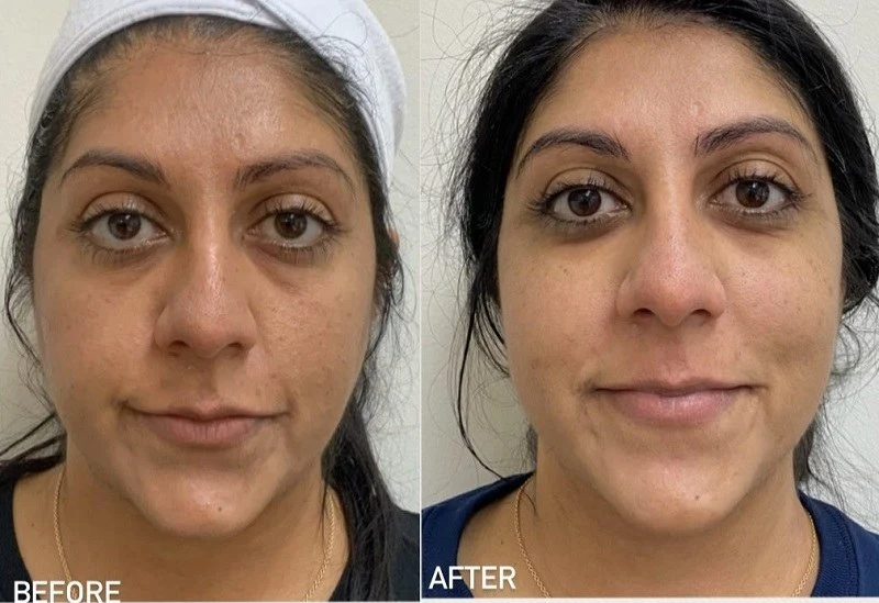 Morpheus 8 Treatment before after