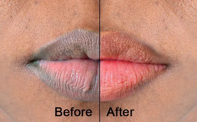 Smokers lips treatmnet before after results in riyadh