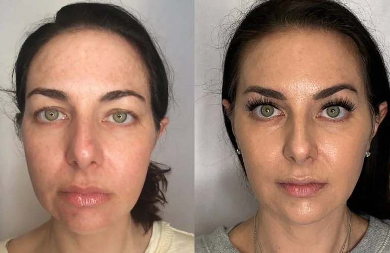 Thread Lift Before After Results