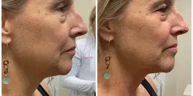 caryotherapy before after results