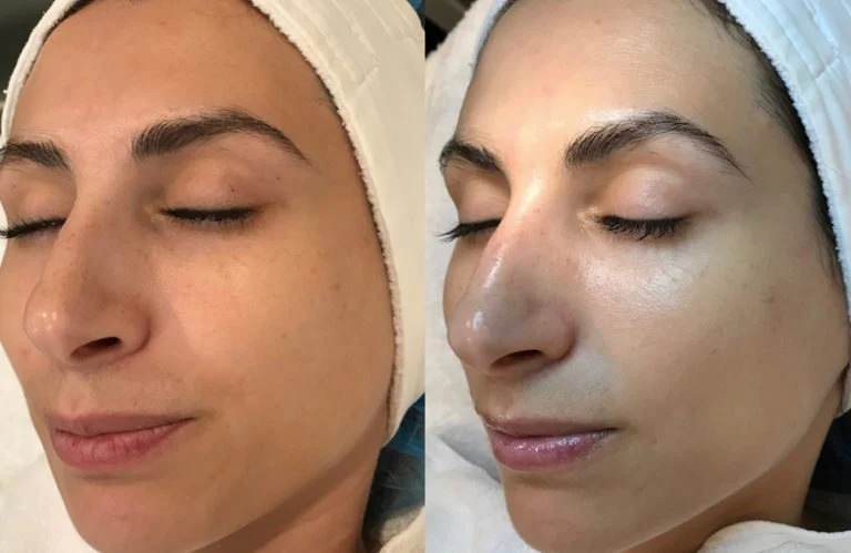 caryotherapy before after