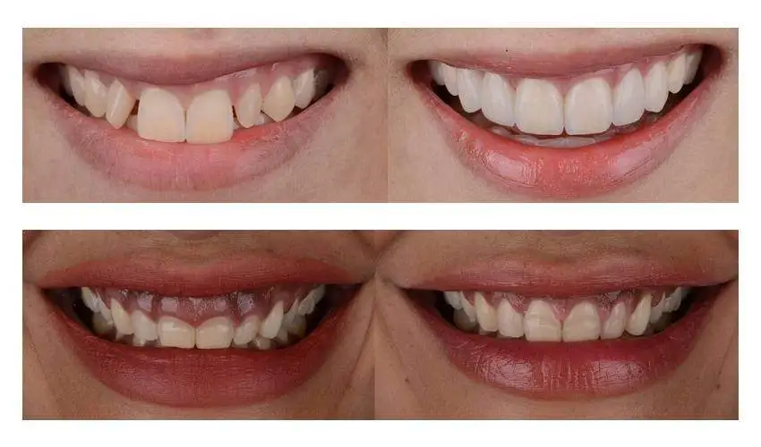 ceramic braces before after resultys