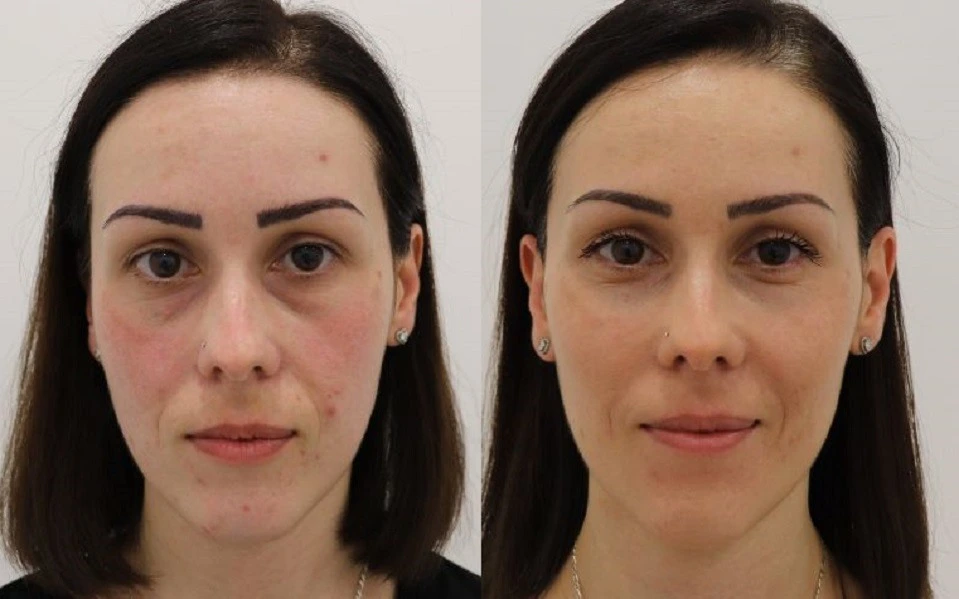 volite fillers before after results