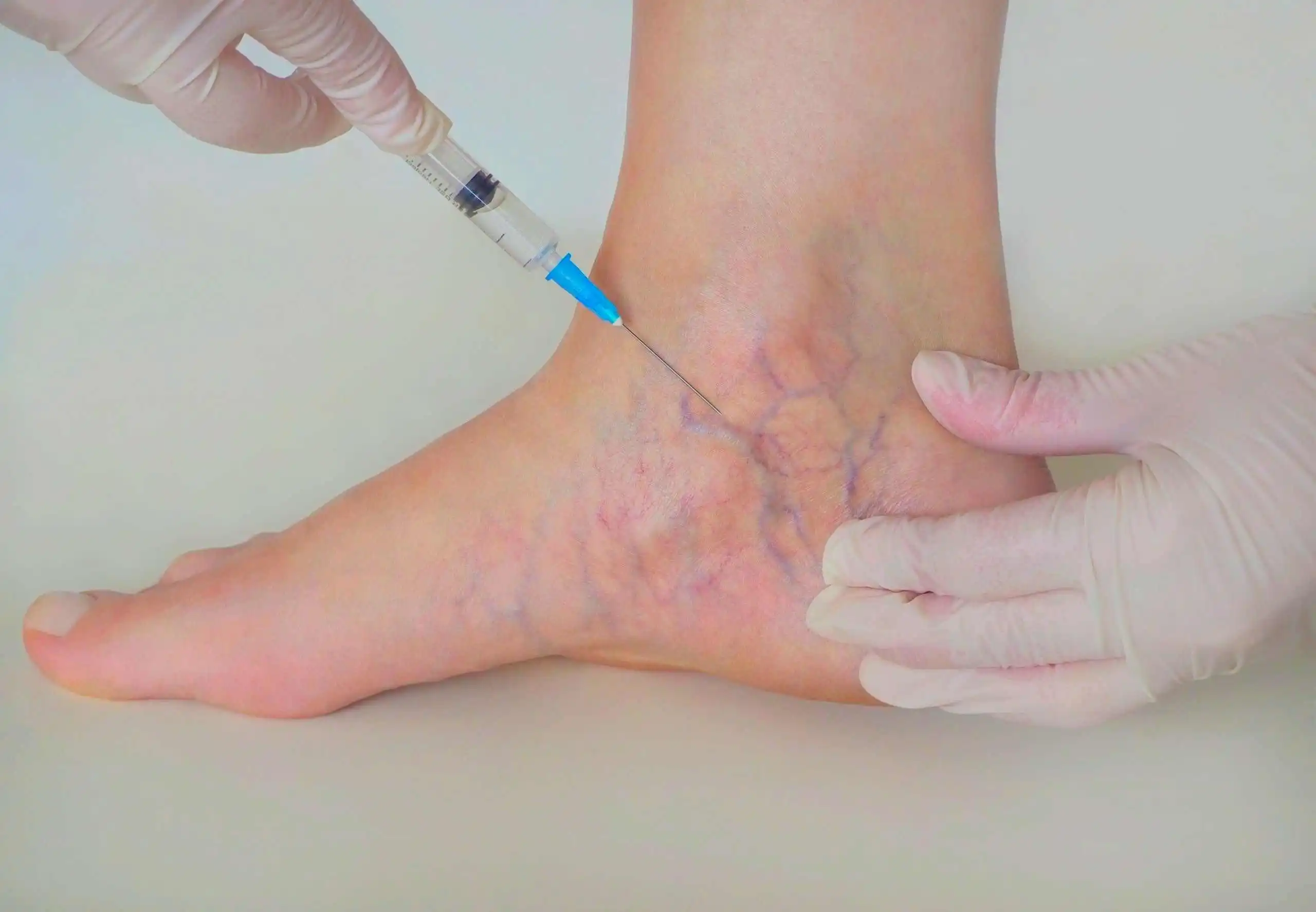 Cost of Sclerotherapy Injections in Riyadh