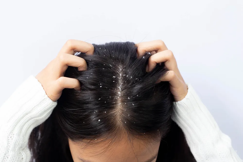 Severe Dandruff Treatment Cost in Riyadh