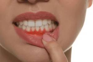 Cost of Gum Recession Treatment in Riyadh