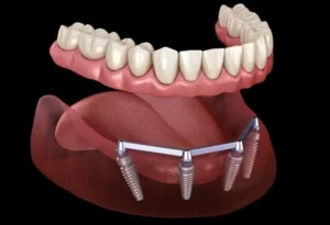 Full Mouth Rehabilitation Cost in Riyadh