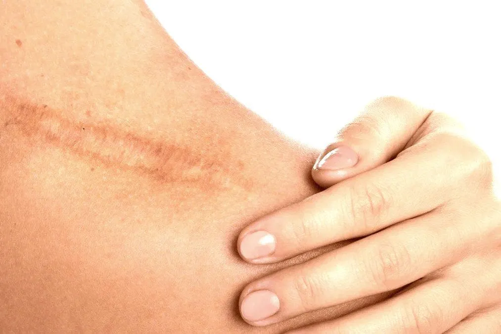 Hypertrophic scar Treatment Cost in Riyadh