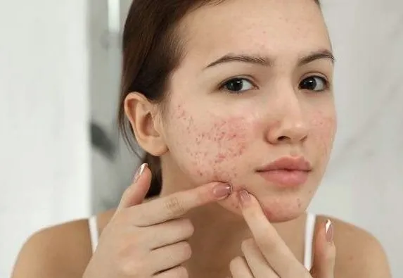 acne treatment procedure