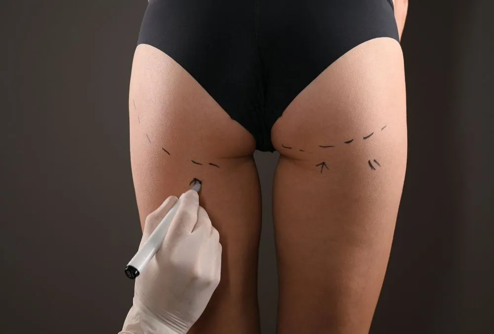 butt augmentation procedure