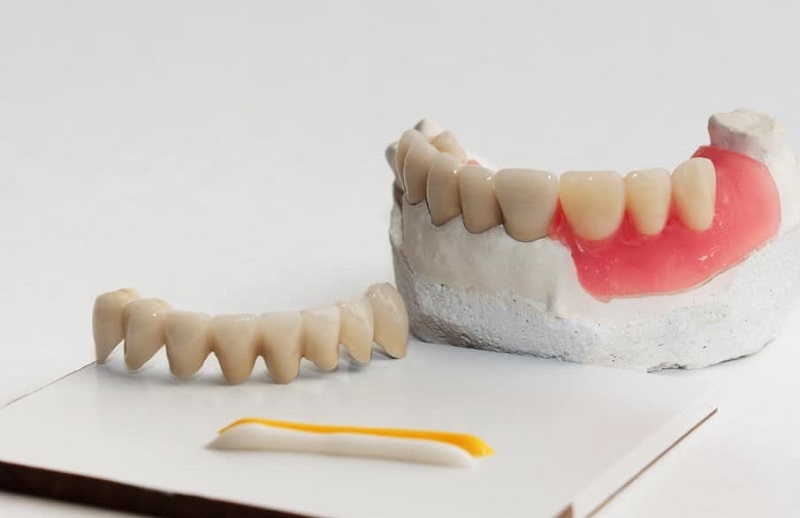 how dental bonding cement work