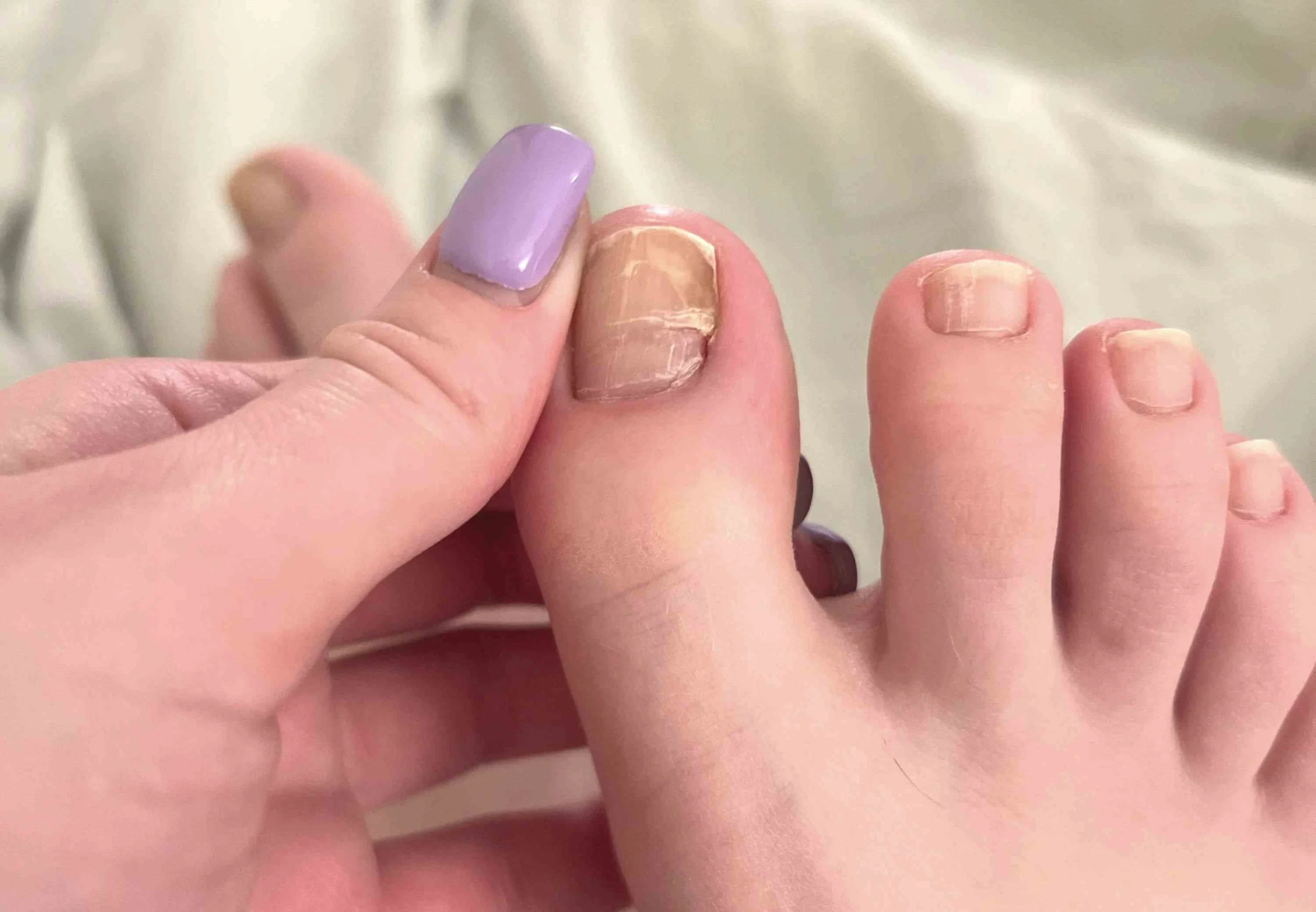 Ingrown Toenails