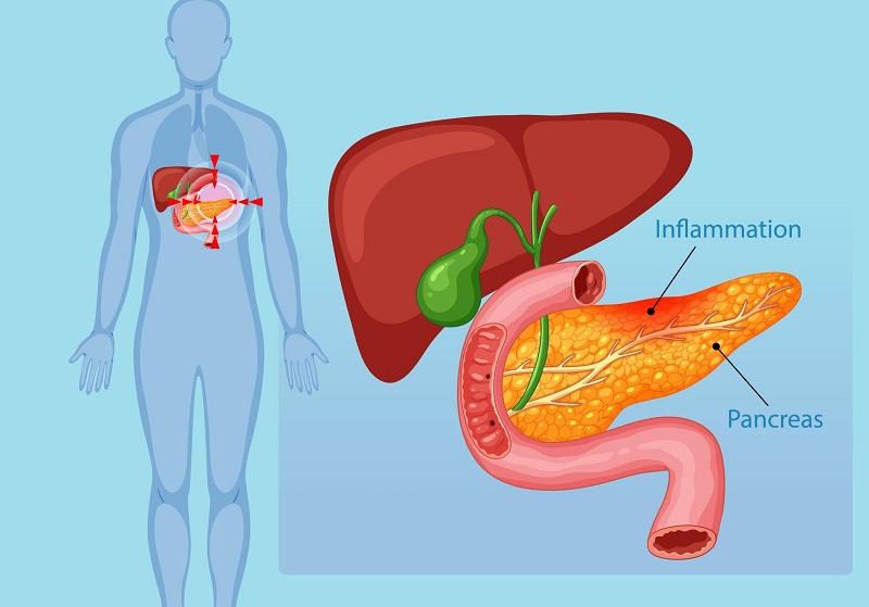 Pancreatic Infections Finding the Best Care in Riyadh