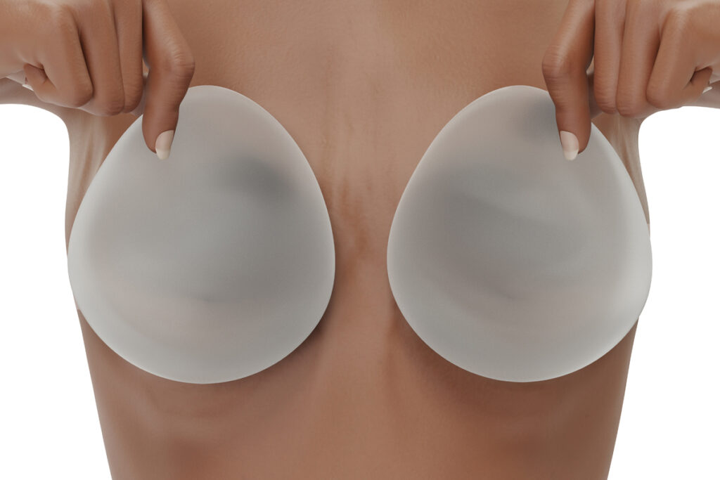 breast implants '