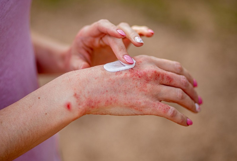 Eczema Treatment cost in riyadh