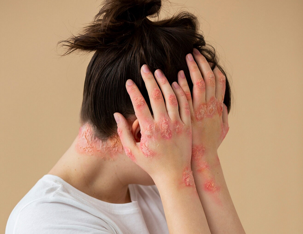 Eczema Treatment in riyadh