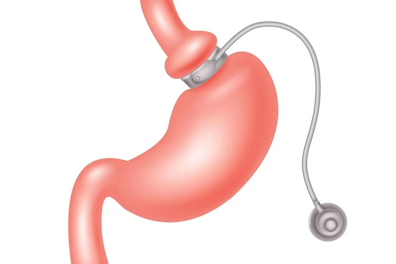 Gastric Bypass Surgery in Riyadh