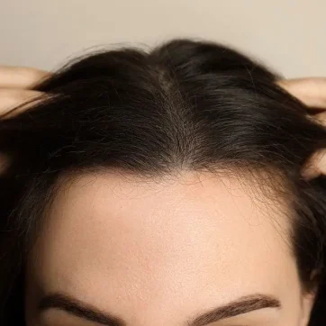 Female hair transplant Cost in riyadh