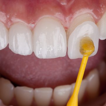 Teeth Fracture Treatment in saudi arabia