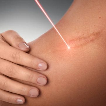 laser scar removal treatment in riyadh